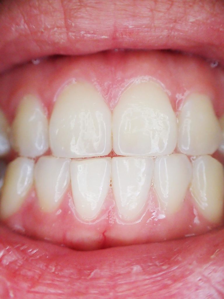 weiße Zähne