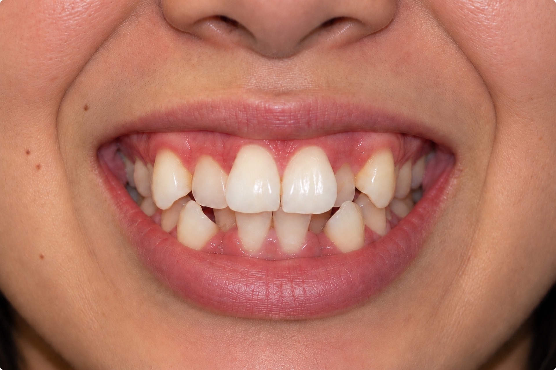 Béance dentaire avant traitement orthodontique, cas 2
