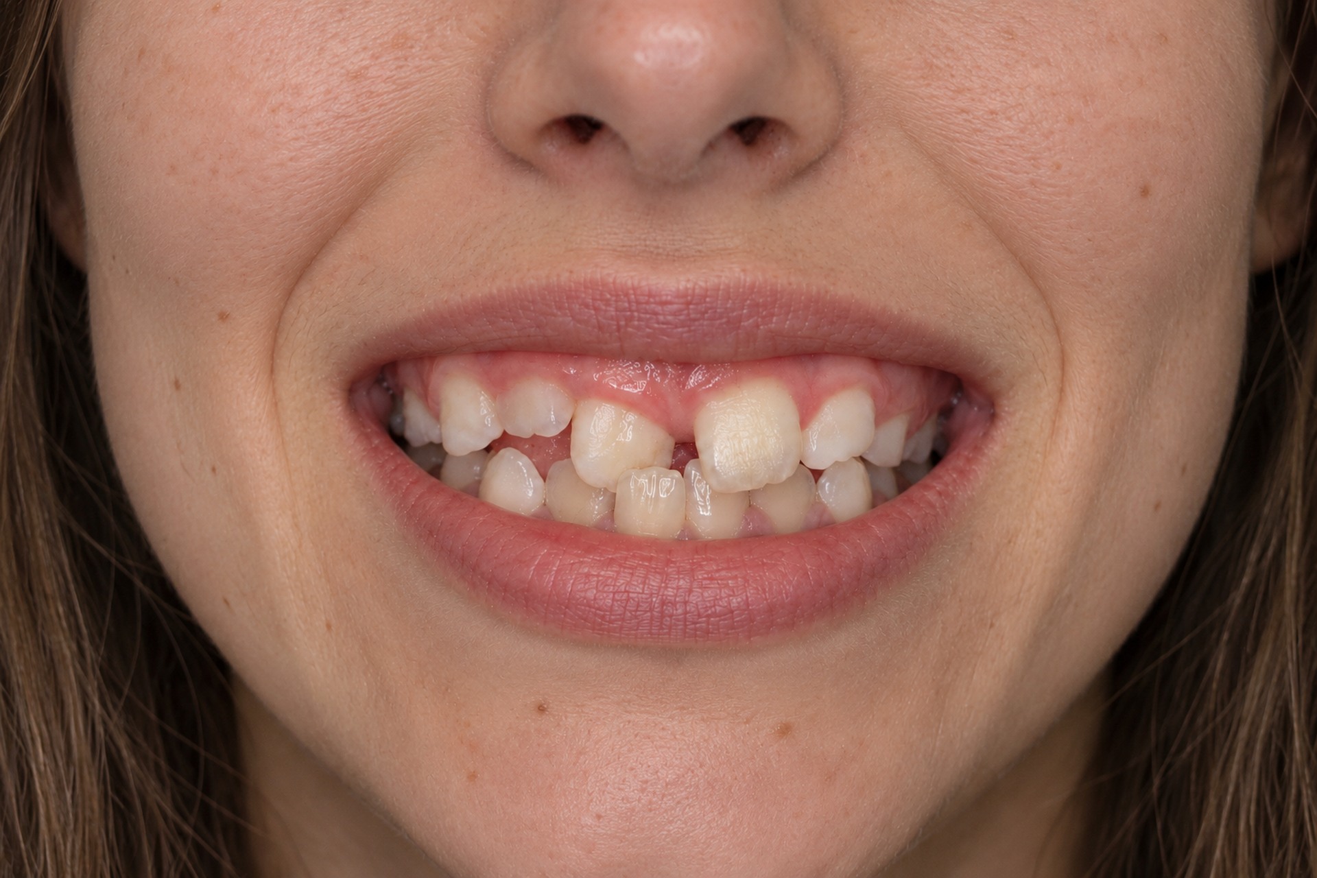 Béance dentaire avant traitement orthodontique, cas 3